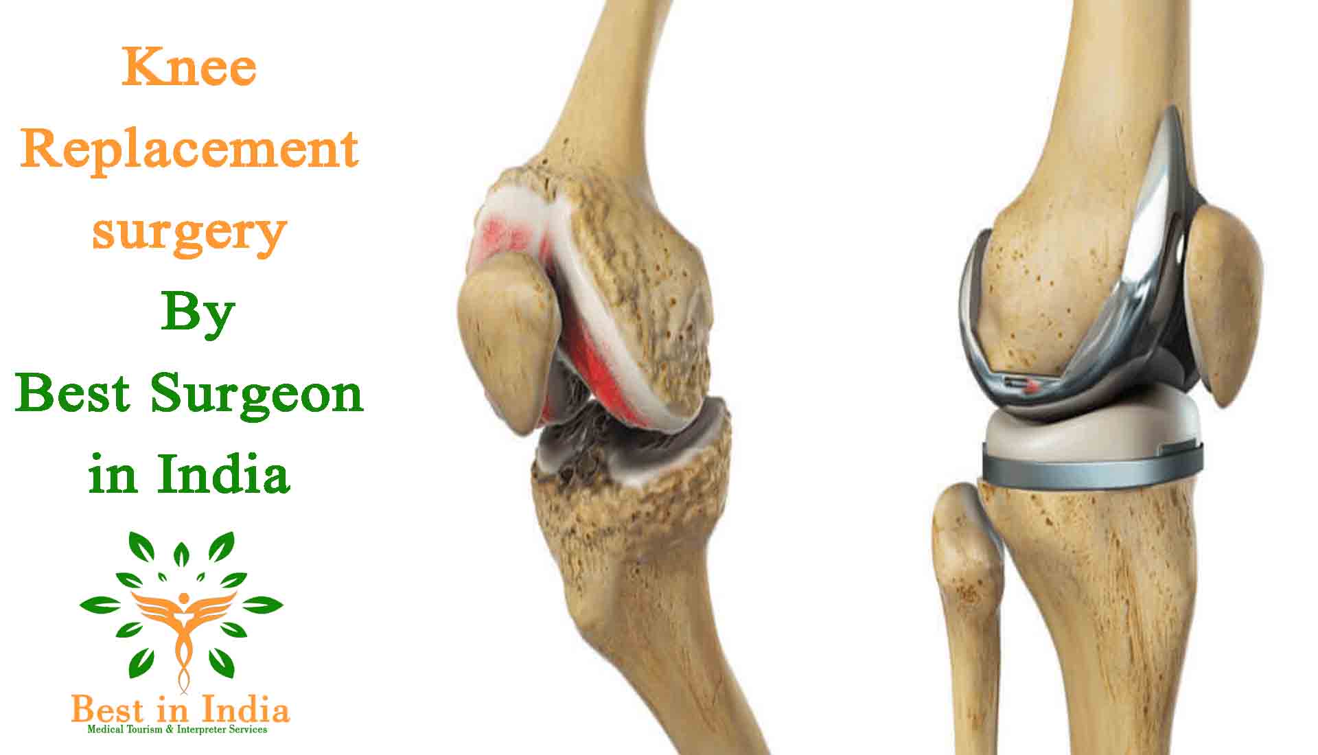 Minimally Invasive Total Knee Replacement - +302107786868