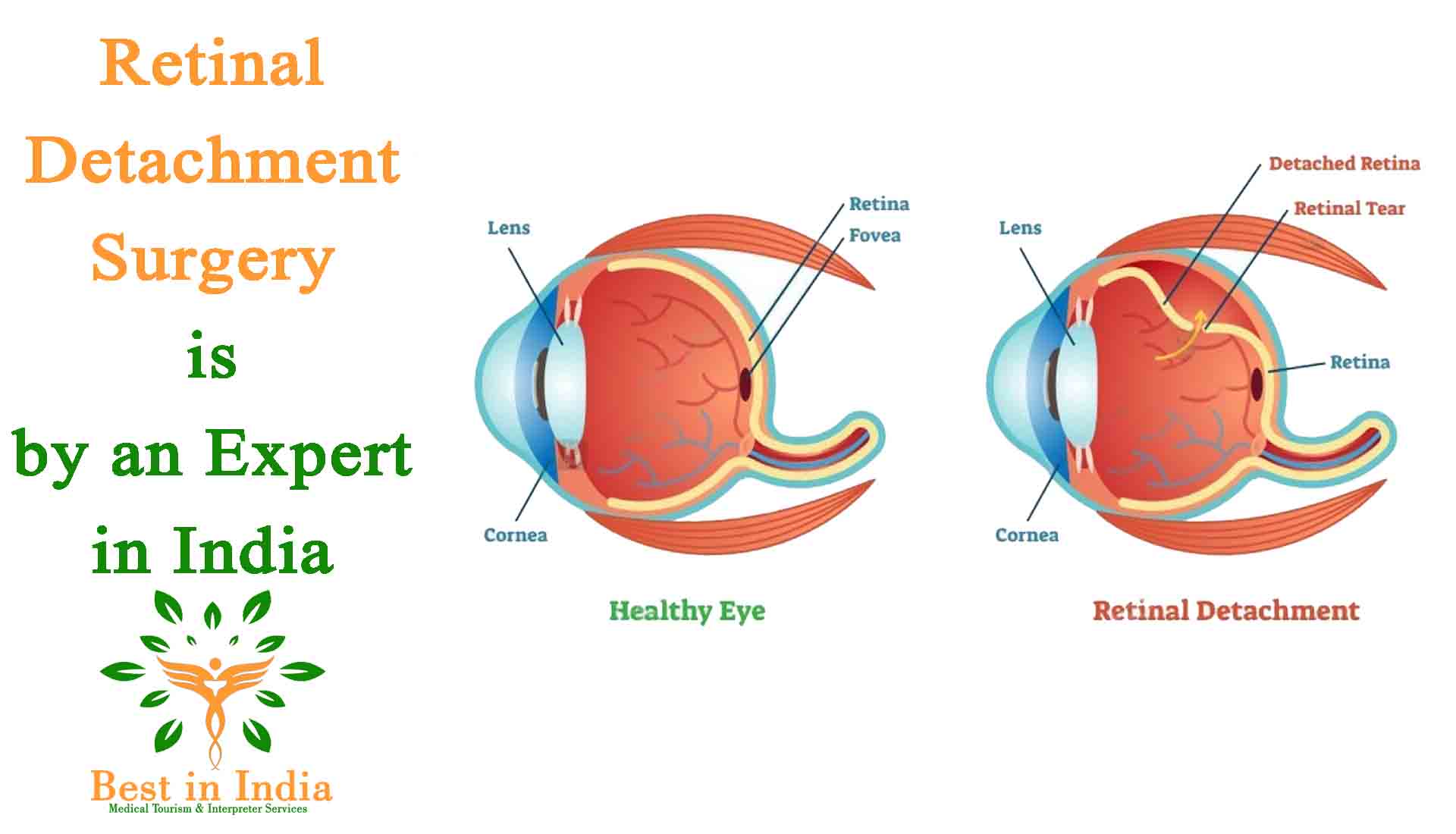 What Causes Retinal Detachment?