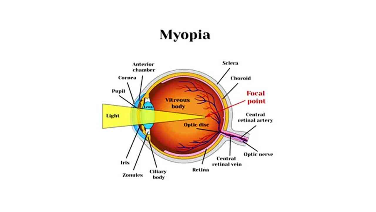 Myophia - LASIK eye surgery