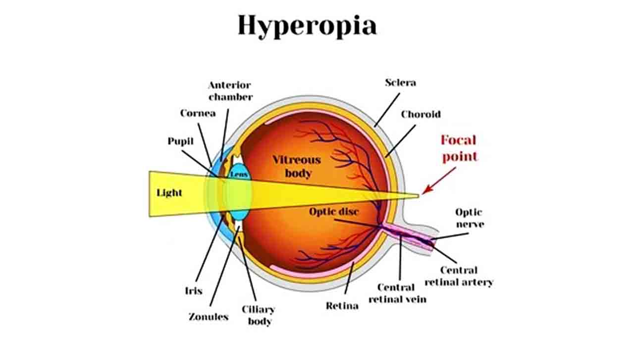 Hyperopia - LASIK eye surgery