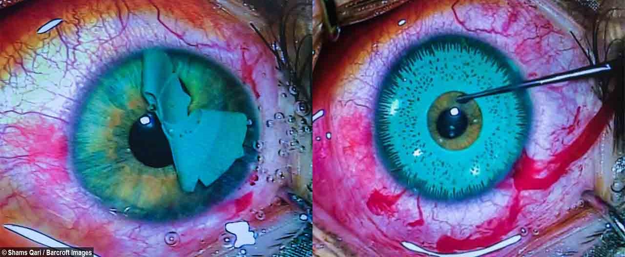 BrightOcular Eye color change Implants