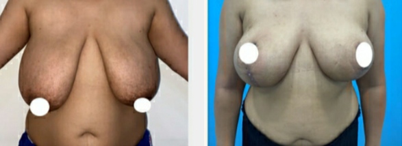 Beast lift, breast surgery, breast augmentation, breast reduction, breast lift home, Breast lift surgeon, Breast reduction surgeon, Breast lift clinic, breast implant surgery, Breast implant surgeon, Breast implant clinic,