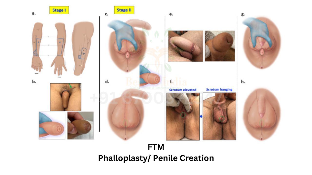 penile Creation or phalloplasty FTM Female to male surgery