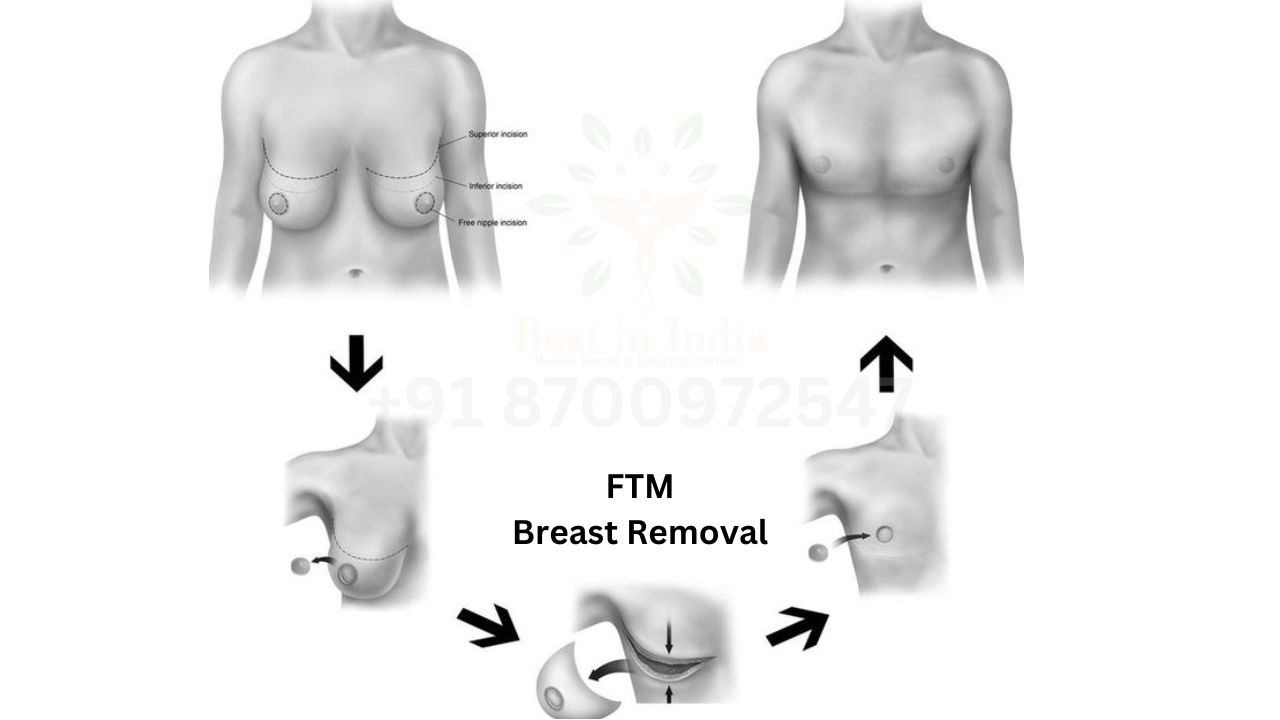 Breast removal for female to male surgery - Mastectomy Top Surgery