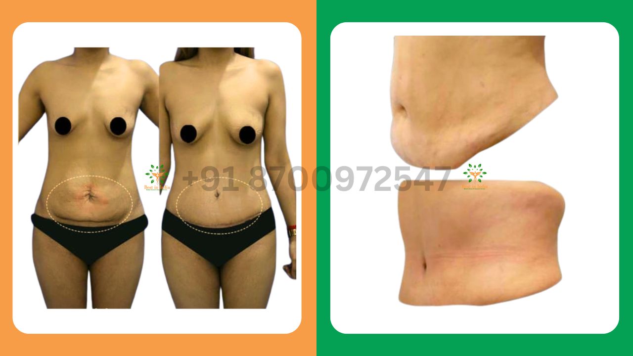 Mommy Makeover - tummy tuck