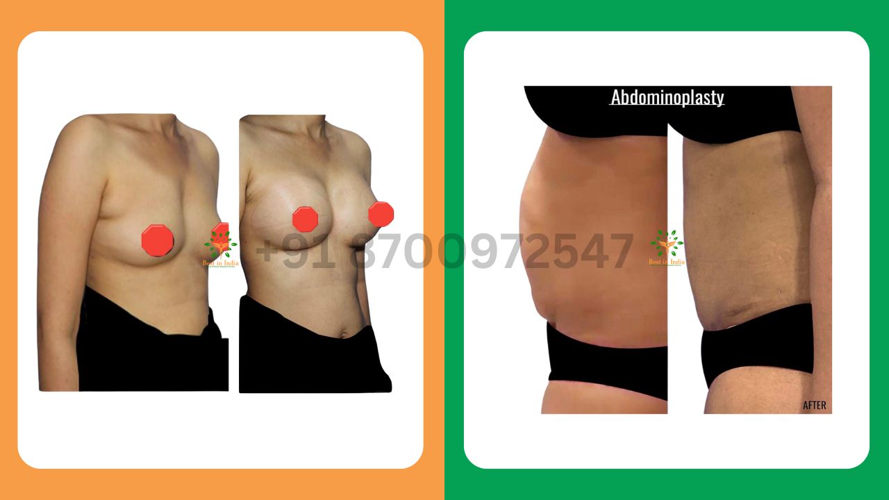 Mommy Makeover - tummy tuck