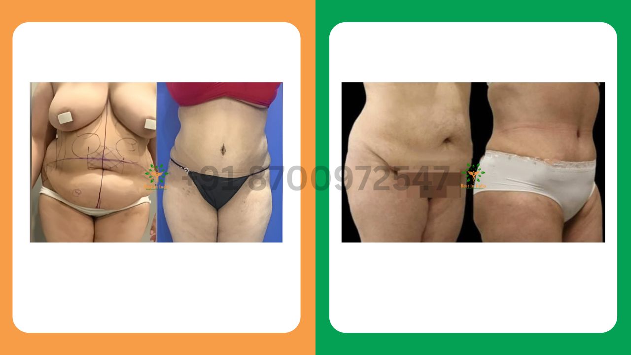 Mommy Makeover - tummy tuck