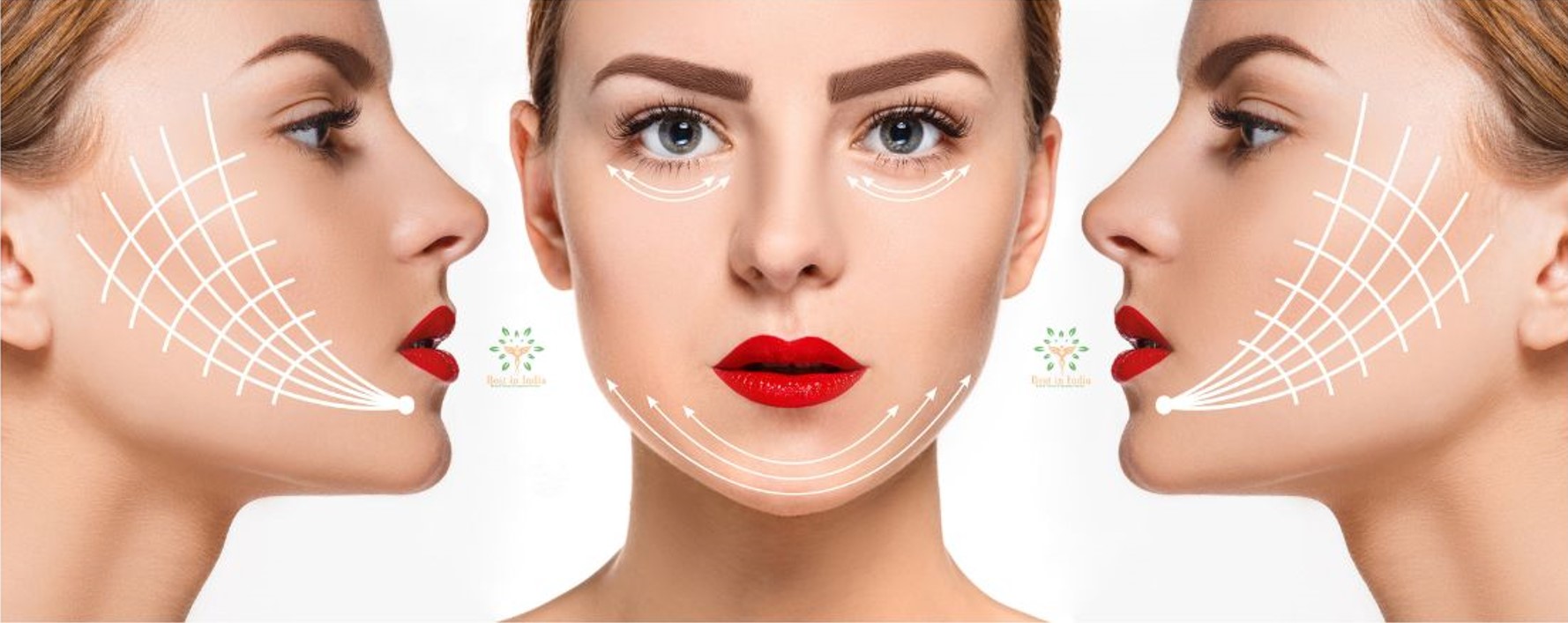 Facelift surgery